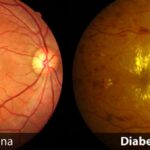 la-retinopatia-diabetica